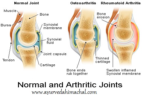 arthritic_joints.jpg