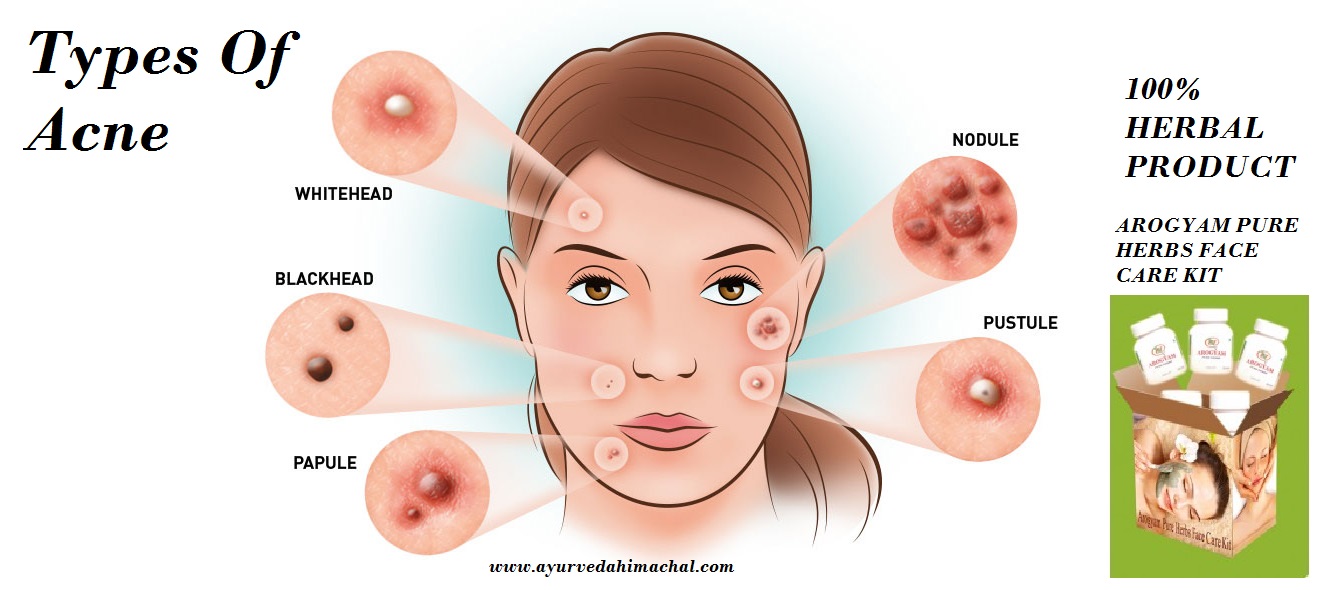 types of acne.jpg