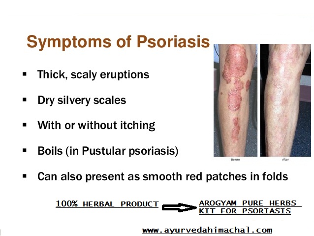 psoriasis-causes.jpg