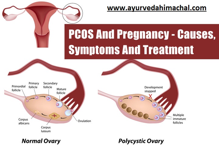 PCOS-And-Pregnancy.jpg
