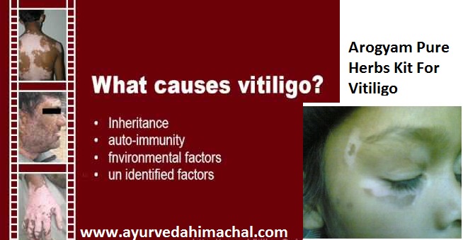 vitiligo reasons.jpg