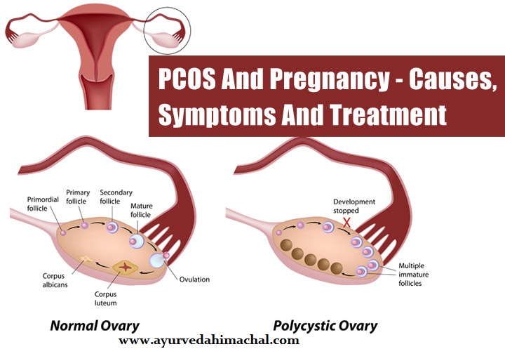 PCOSayurveda.jpg