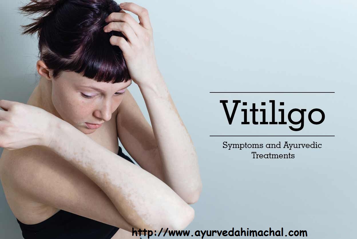 vitiligo treatment.jpg