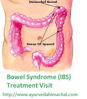Irritable-Bowel-Syndrome-IBS.jpg