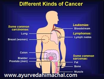 cancer-type.jpg cancer-type.jpg