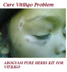 arogyam_vitiligo-228x228.jpg